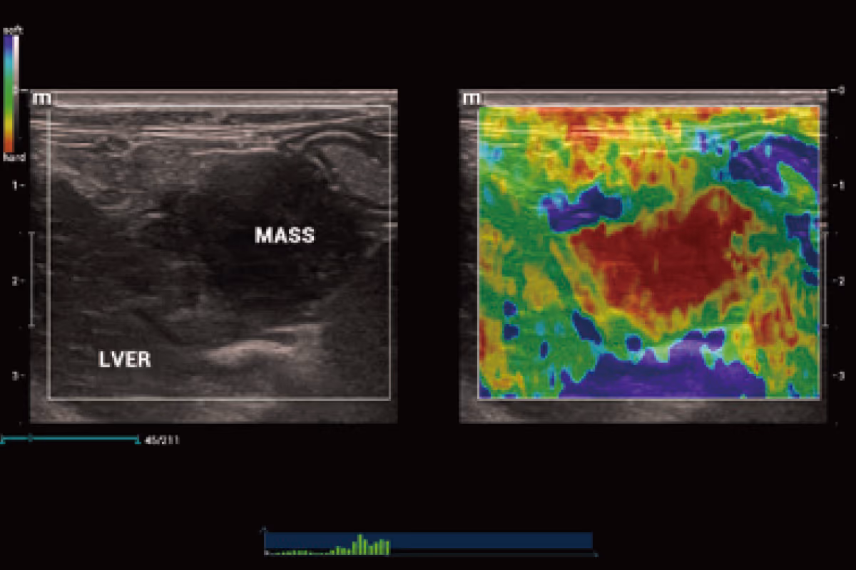 Doğal Dokunuş Elastografisi