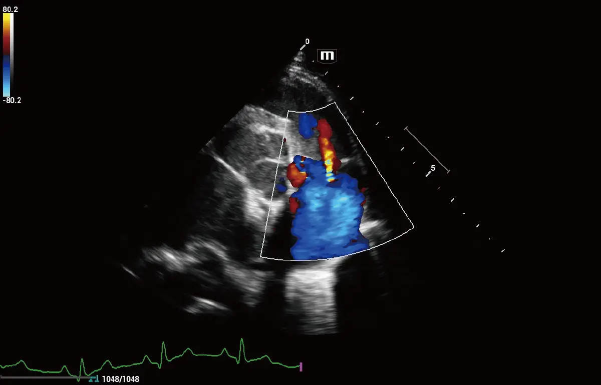 Köpeklerde Akciğer Regürjitasyonu