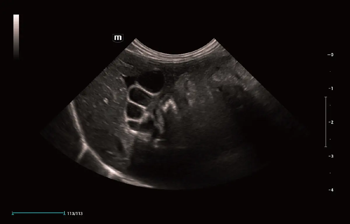 Kedi Safra Kanalı Genişlemesi