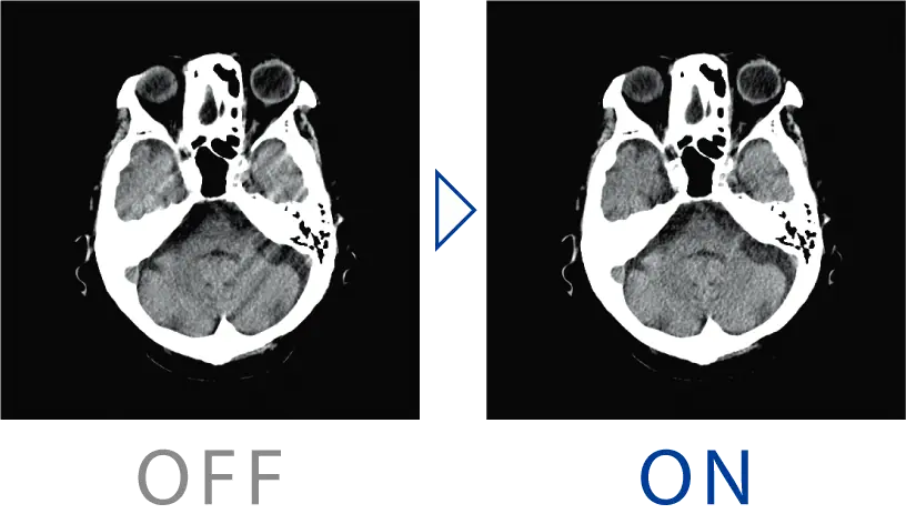 Hareket artefaktı düzeltmesi
