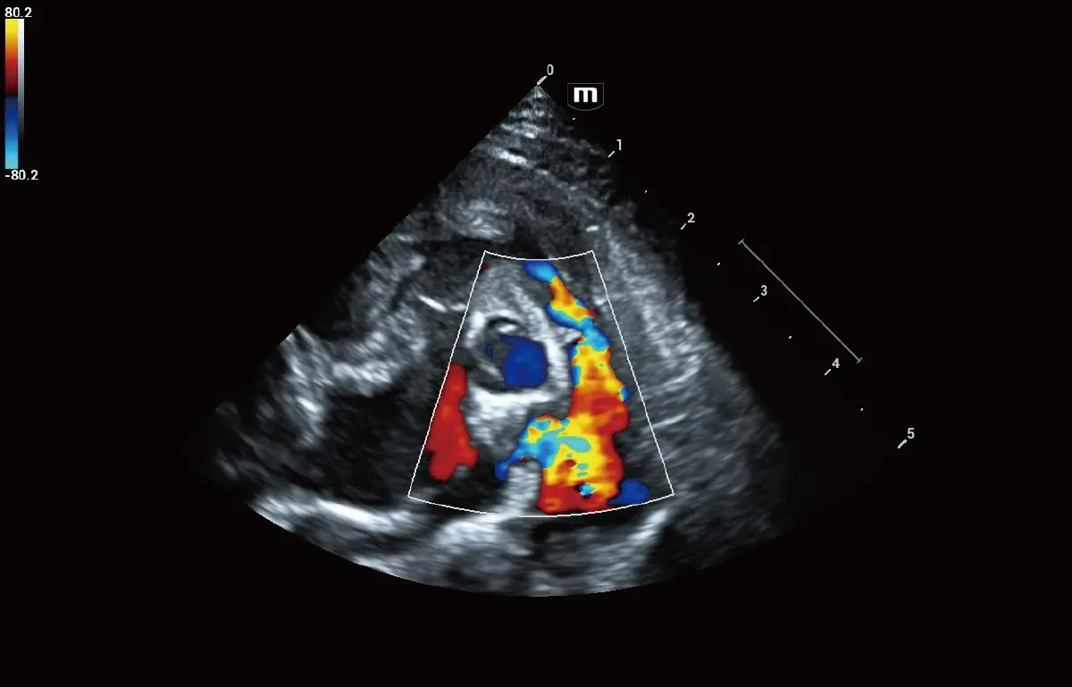 Köpek Akciğer Stenozu