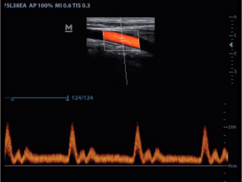 Power Doppler & Pulse Wave