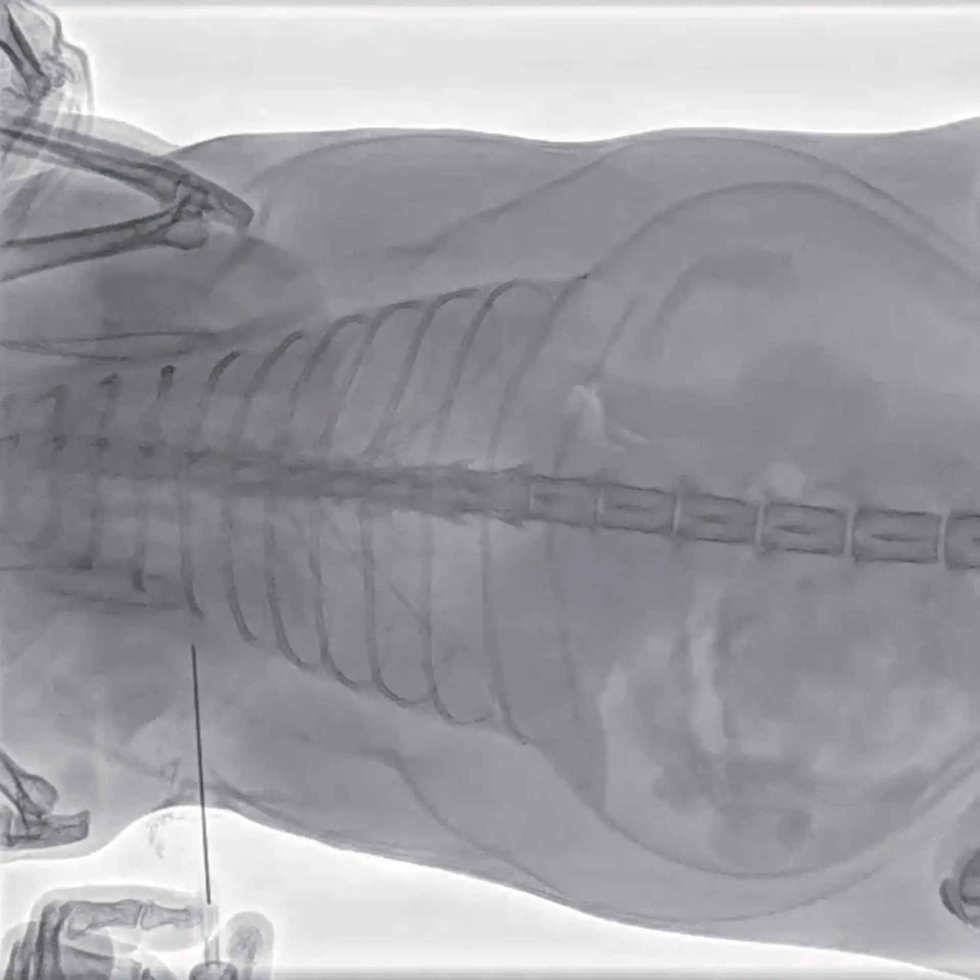 Torasentez örnekleme